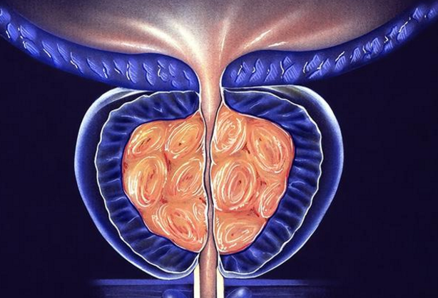 前列腺炎是否可以根治，誤解與真相，前列腺炎的真相，能否根治與誤解解析