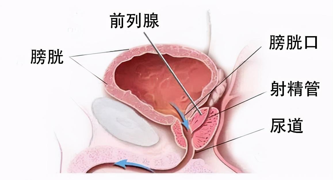 前列腺炎能好嗎？全面解析前列腺炎的治療與康復(fù)，全面解析前列腺炎治療與康復(fù)，能否痊愈？